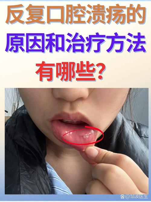 吃皮蛋口腔黏膜灼伤,吃皮蛋口腔黏膜灼伤怎么办